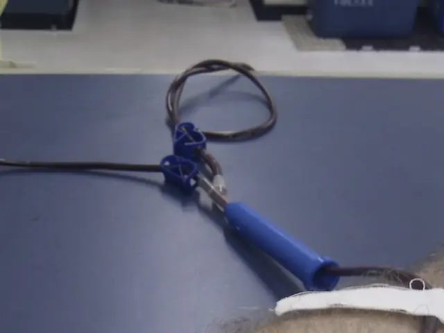 Medical professionals successfully separate conjoined twins, with one sibling having leg-like...